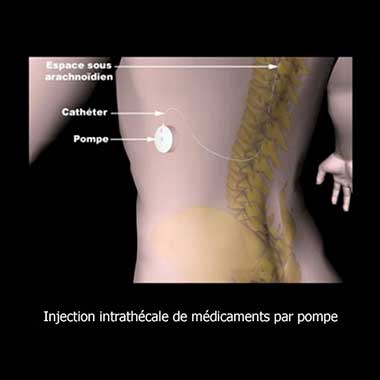 injection-intrathecale-par-pompe